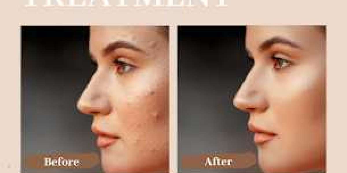 Combat Acne Woes with Advanced Treatments at Derma 360 Clinics in KPHB