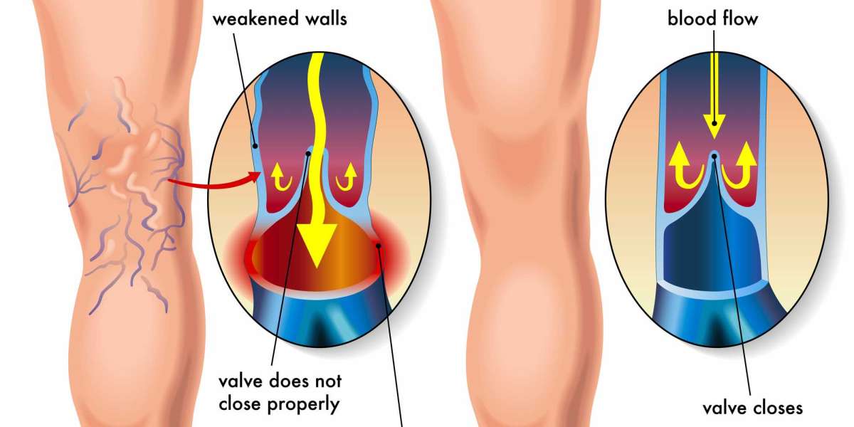 Deciphering Varicose Veins: A Journey Through Diagnosis to Recovery