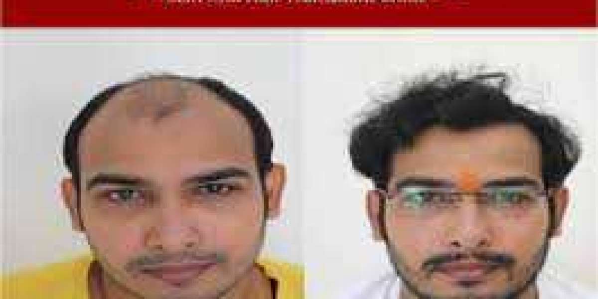 Premier Hair Specialist Doctor in Raipur- Skinroots Clinic