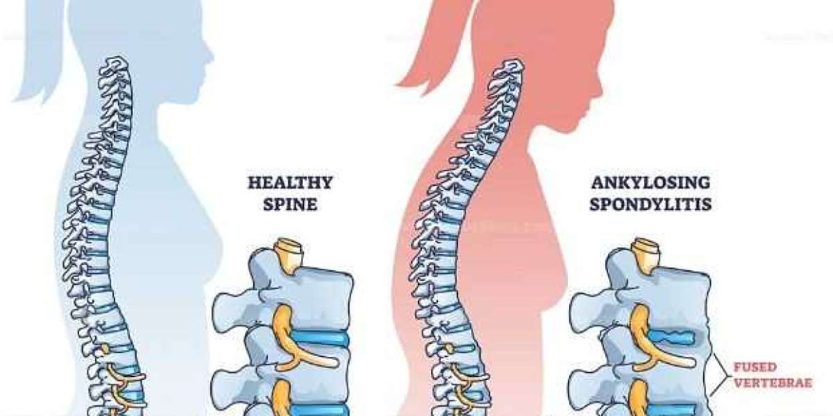 Ankylosing Spondylitis Disease in Focus: A Holistic Approach to Understanding and Managing the Disease