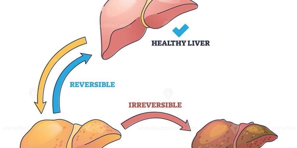 Cirrhosis Disease: Investing in Innovation for Advanced Care | DLI