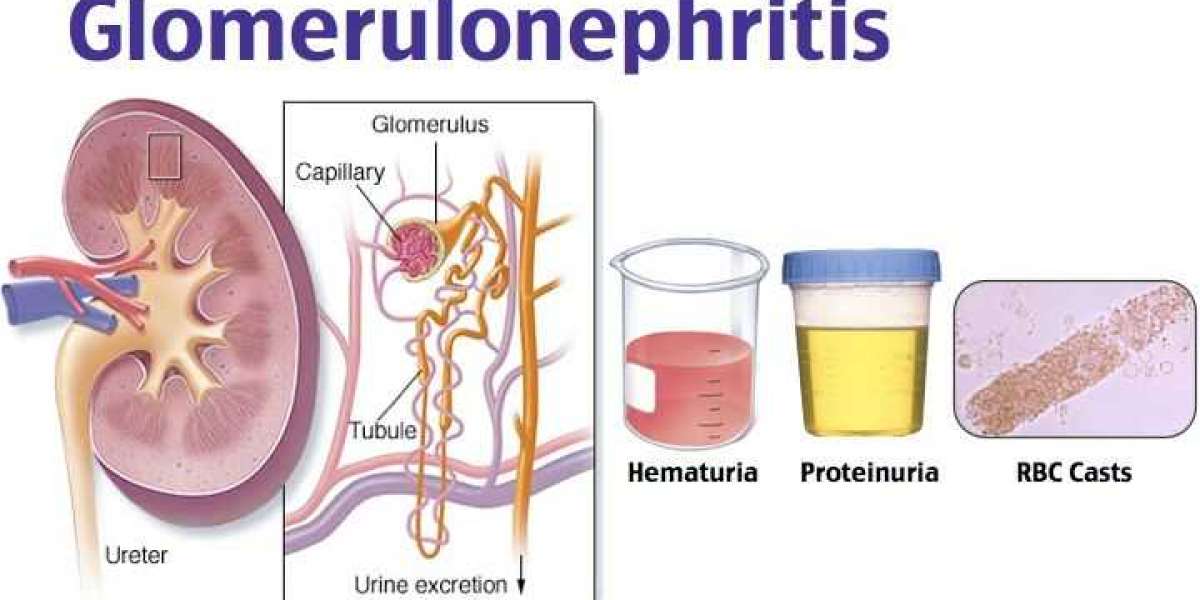 Market Dynamics and Treatment Approaches for Glomerulonephritis Disease | DLI