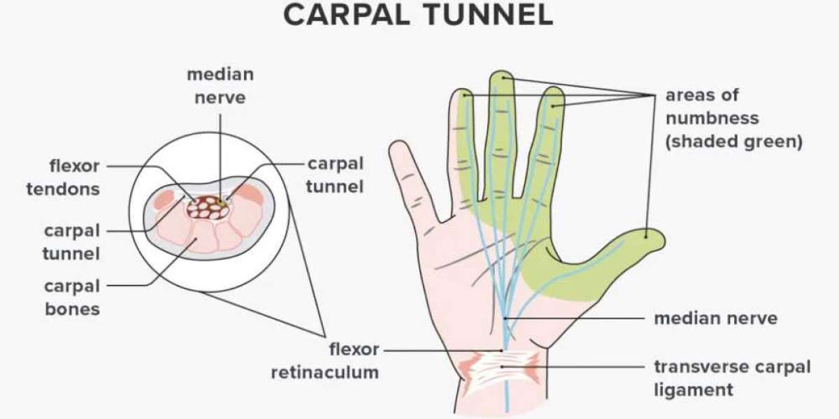 Infection and Beyond: Comprehensive Strategies for Carpal Tunnel Syndrome Care