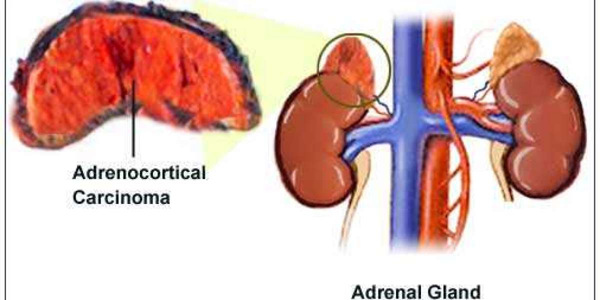 Services Reshaping Adrenocortical Carcinoma Treatment: Insights from Recent Research | DLI