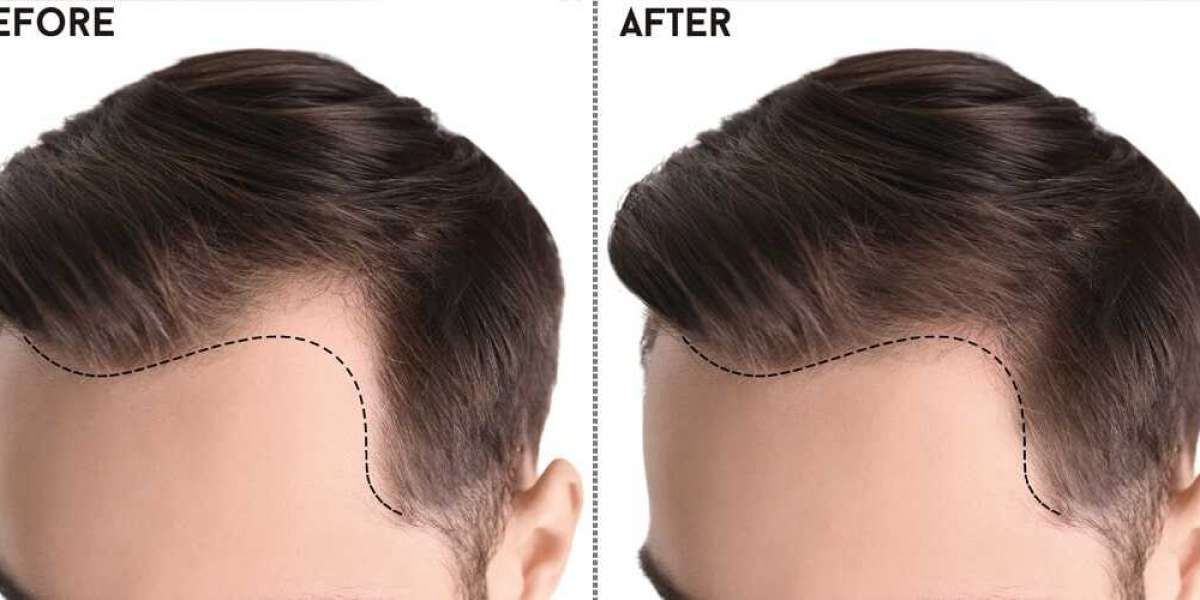 Choosing Excellence: The Ultimate Guide to Finding the Best Hair Transplant in Islamabad