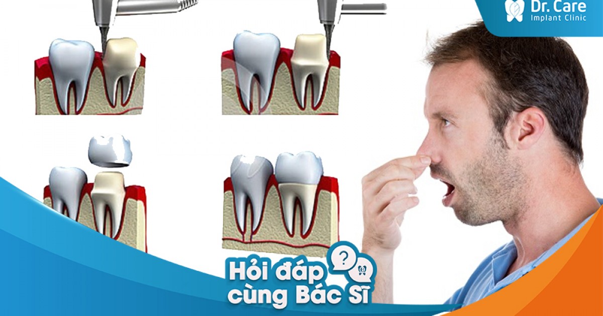 [Hỏi đáp bác sĩ] - Sau khi mài răng bọc sứ, bị tình trạng hôi miệng, nguyên nhân do đâu? | Dr. Care