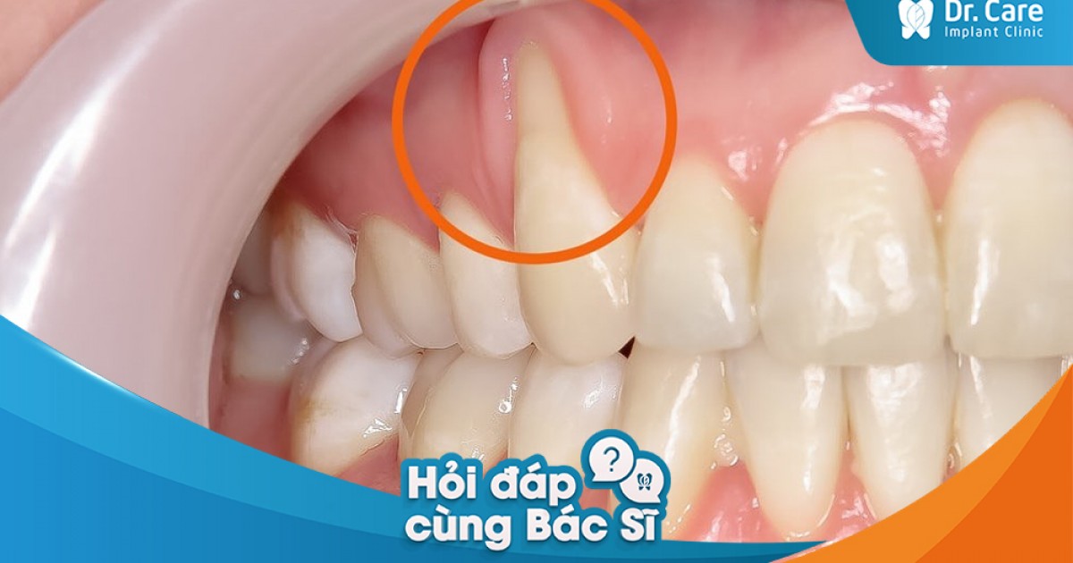 [Hỏi đáp bác sĩ] - Nướu răng bị tụt sau khi mài răng bọc sứ, nguyên nhân do đâu? | Dr. Care