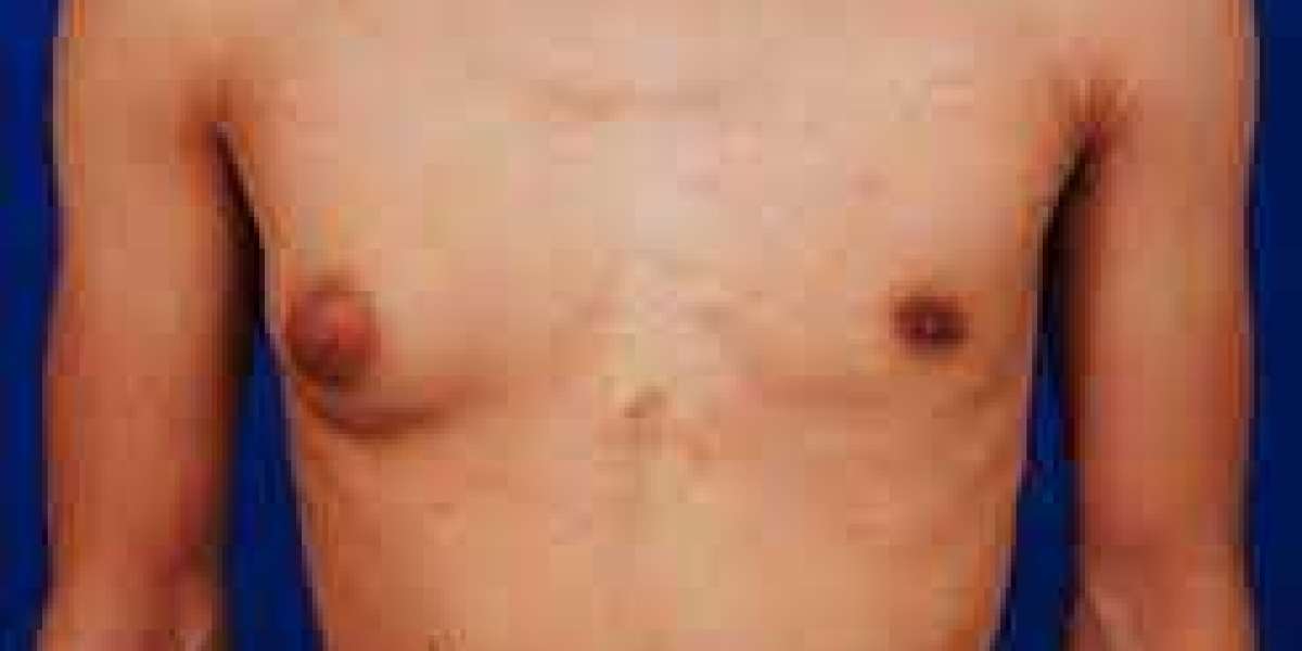 Comprehensive Guide to Gynecomastia Surgery in Lahore