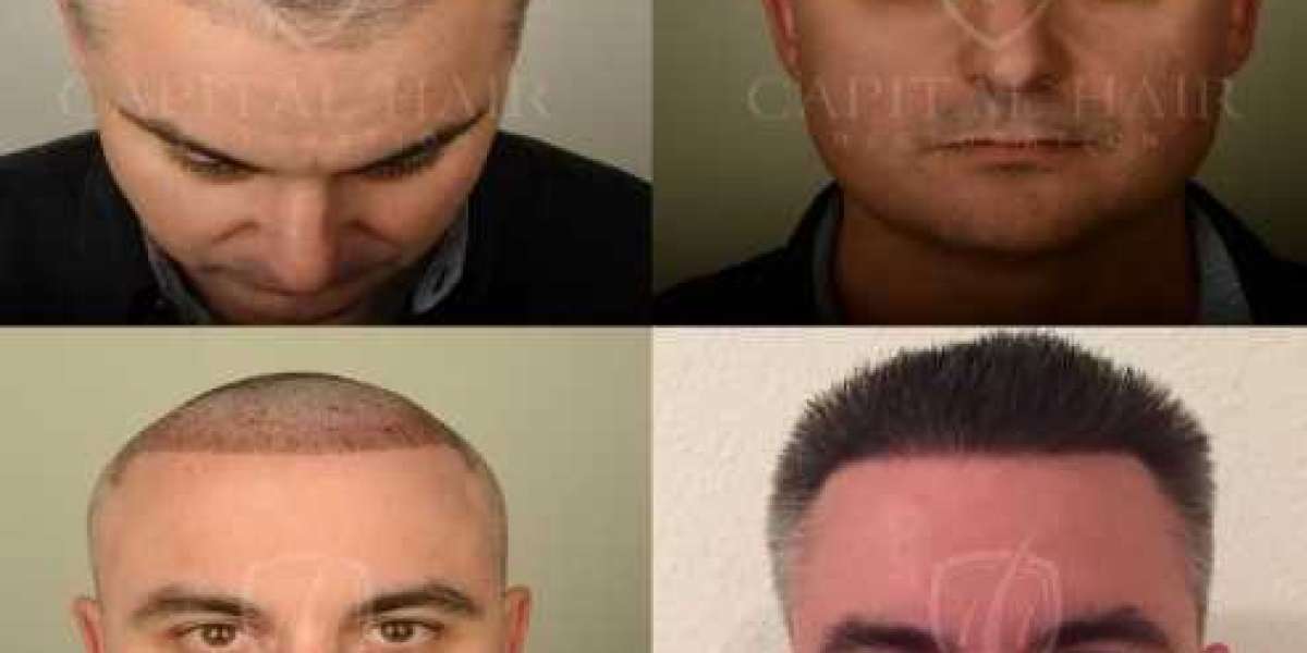 Decoding Hair Transplant Costs A Comprehensive Guide