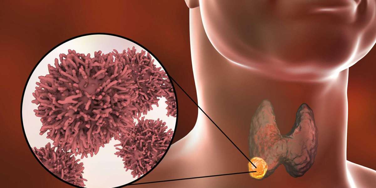 Medullary Thyroid Cancer Market Size, Analysis, Industry Statistics and Latest Insights Till 2034