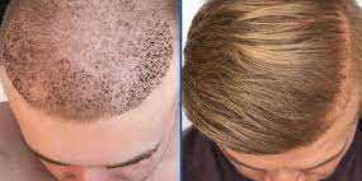 Hair Transplantation Clinic in UAE ?