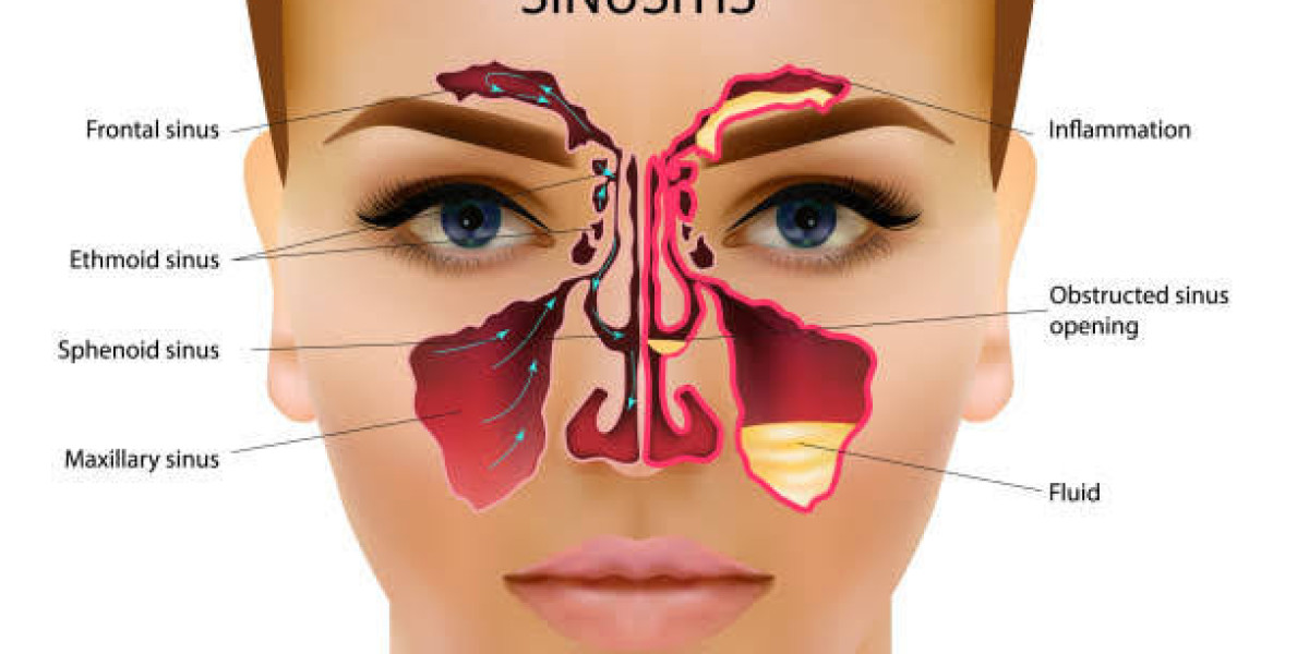 A cute sinusitis