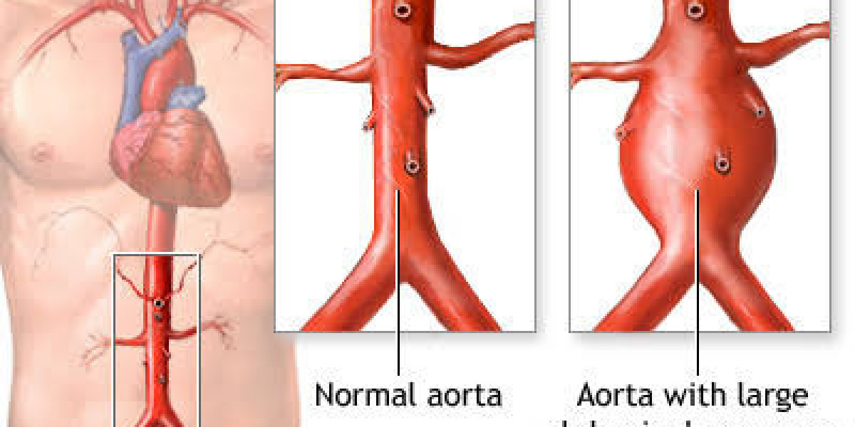 Aortic aneurysm