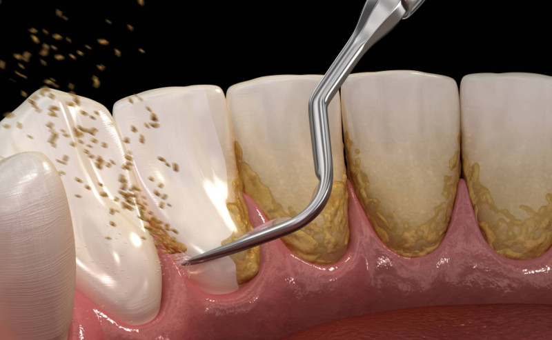 When to Call Your Dentist After Wisdom Teeth Extraction: Signs of Complications : palmdaledentist — LiveJournal