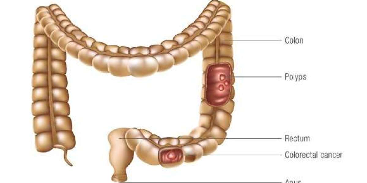 Pediatric Colon/Colorectal Cancer: Special Considerations