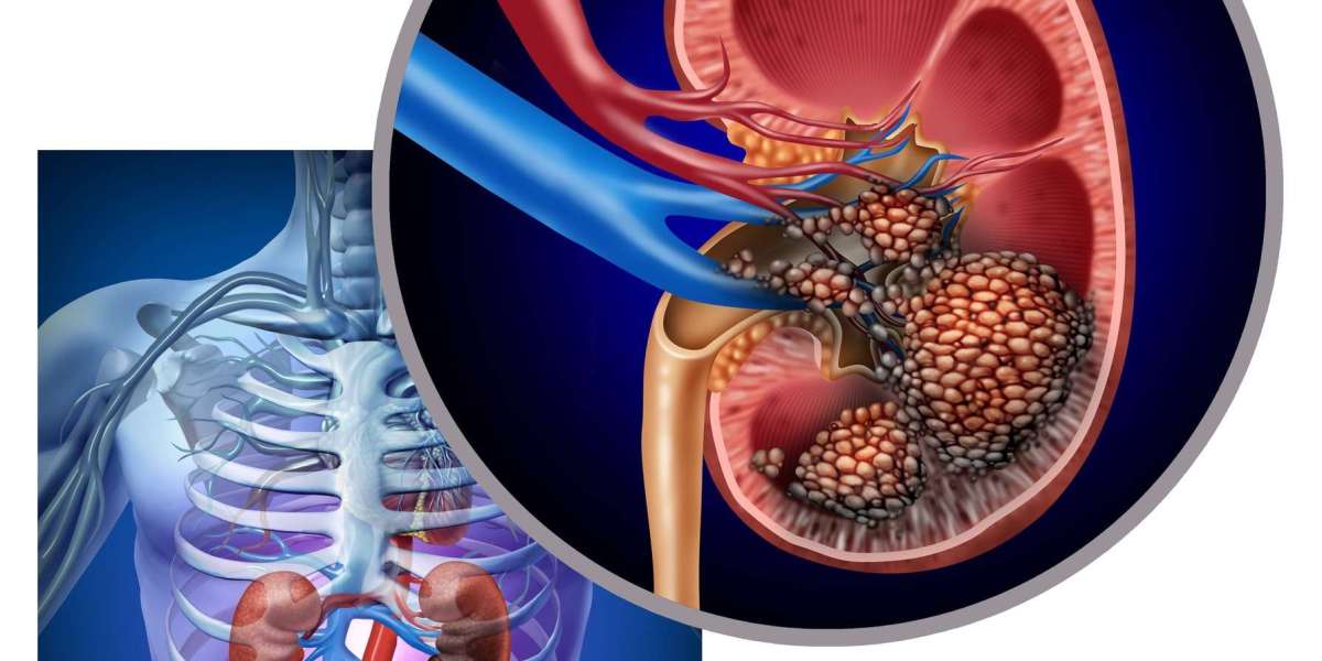 Early Warning Signs: Recognizing Symptoms Of Kidney Cancer