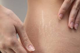 The Miracle of Stretch Mark Removal Laser