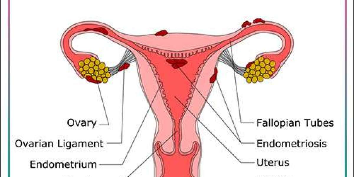 Endometriosis Demystified: Exploring Causes, Symptoms, and Management