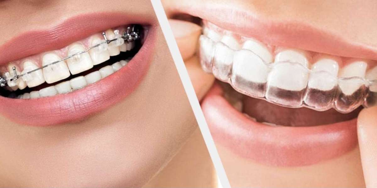 Choosing the Right Orthodontic Treatment for Your Needs