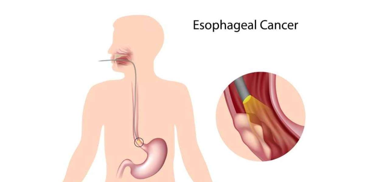 From Heartburn to Cancer: Recognizing Esophageal Cancer Risks