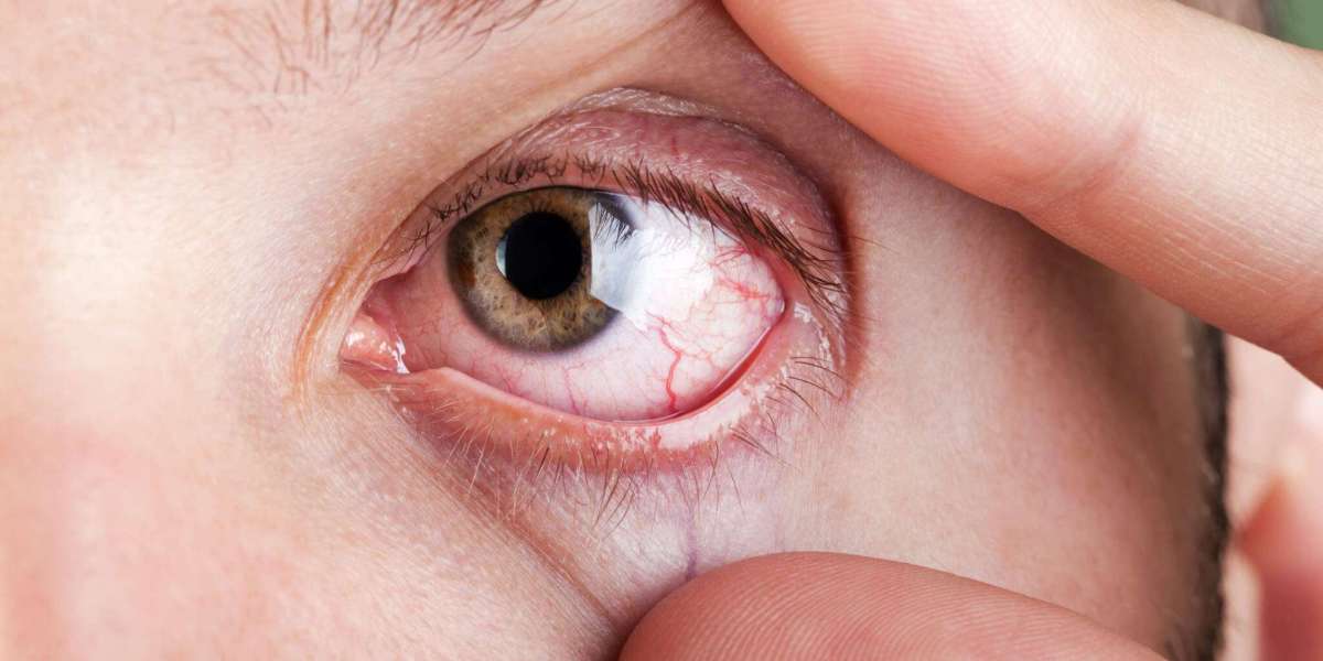 Dry Eye Syndrome Market to Exhibit A Remarkable CAGR of 6.30% By 2030