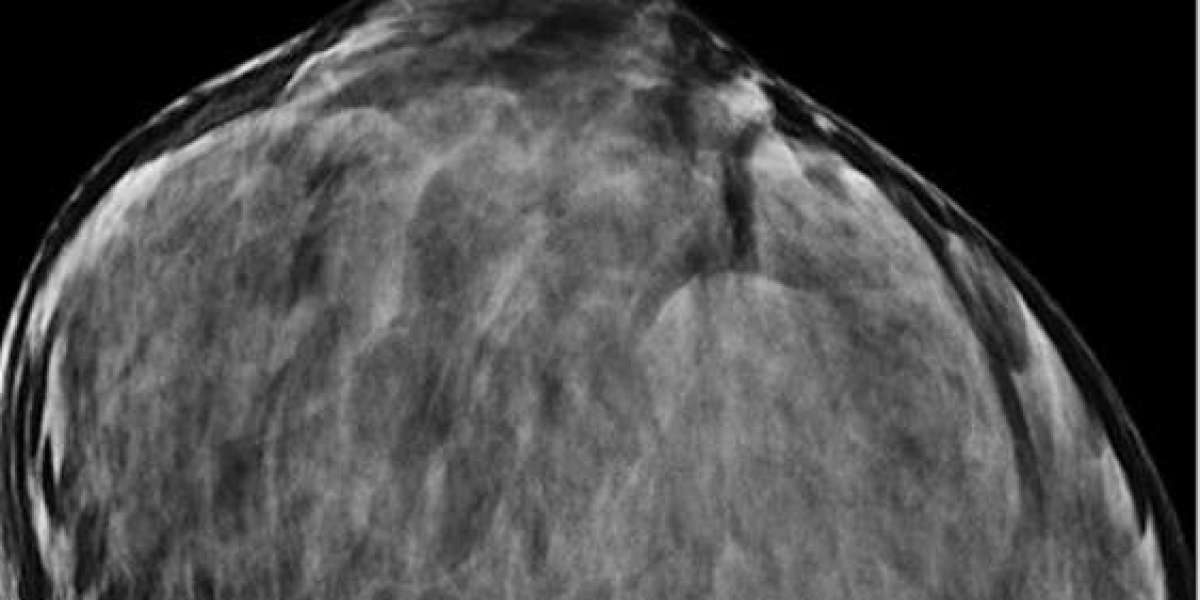 Inside Breast Cancer: Unveiling the Formation and Progression