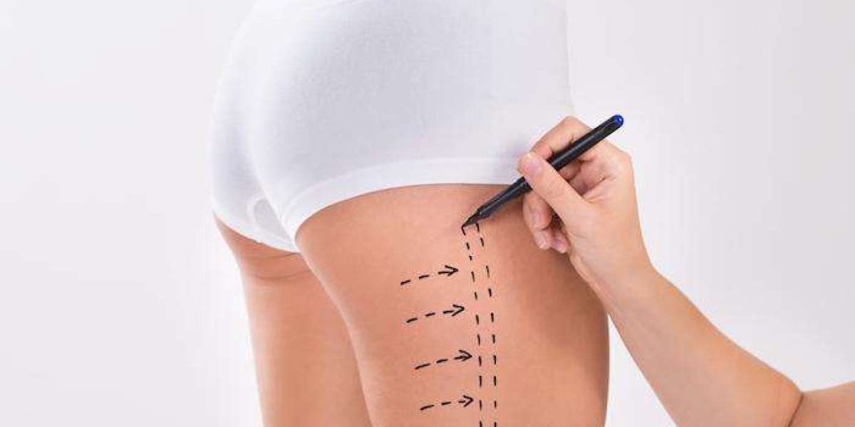 Understanding Anesthesia Options for Liposuction Surgery