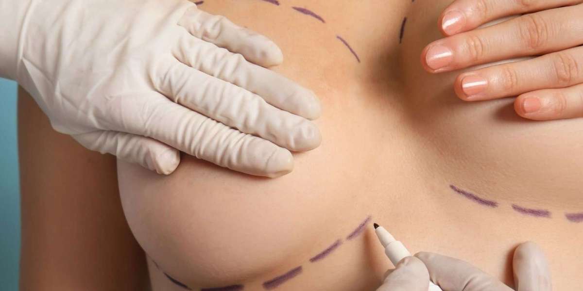 Enhancing Breast Projection Through Fat Transfer