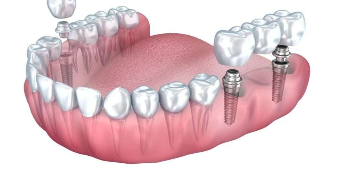 Choosing Dental Implants Over Dentures: A Step-by-Step Guide