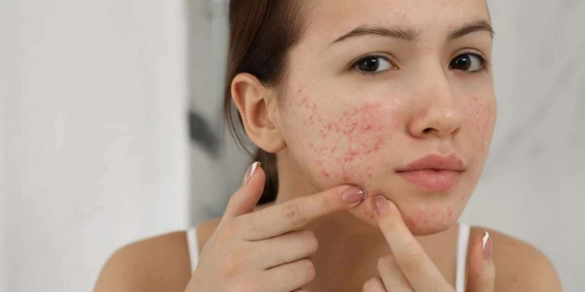 What Are the Benefits of Acne Treatment Before and After?