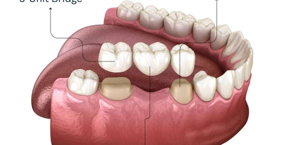 Dental Bridges: Restoring Your Smile and Confidence