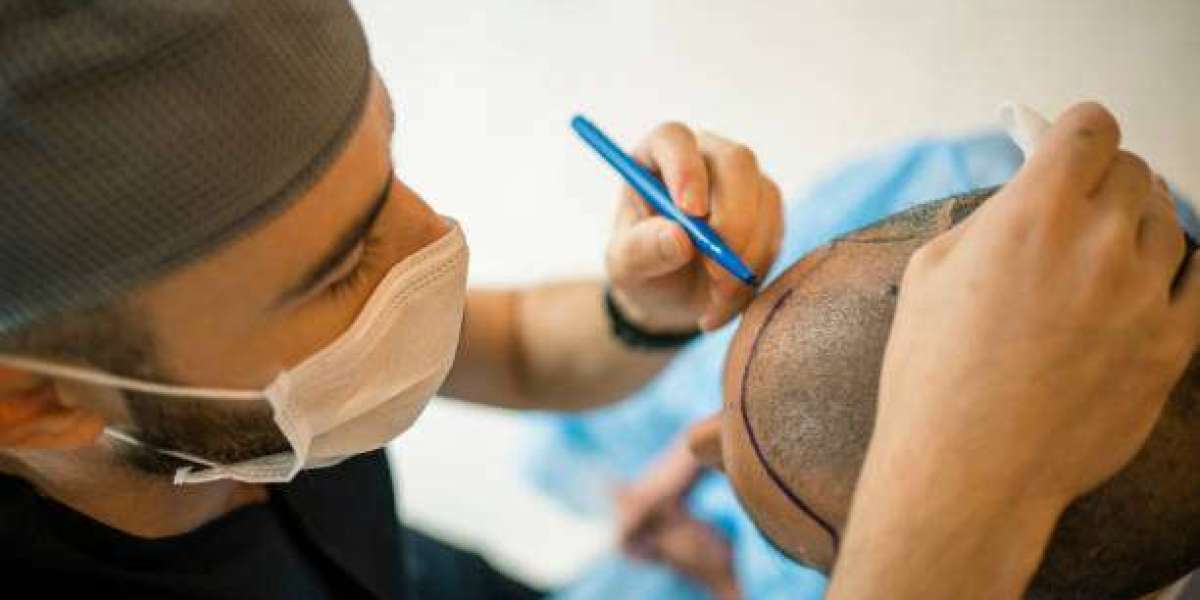 The Cost of Hair Transplants in Riyadh: What You Need to Know