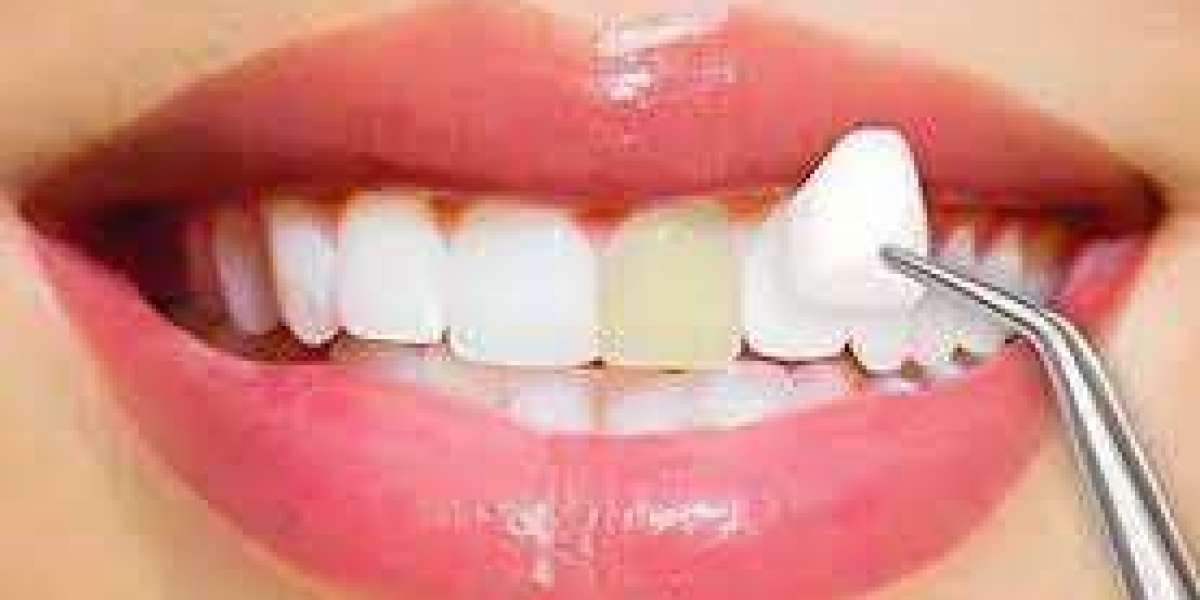 Can I Whiten My Teeth with E-Max Veneers?