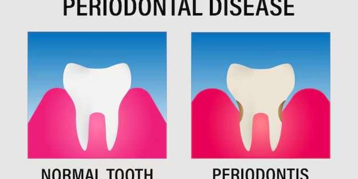 Comprehensive Guide to Periodontal Disease Treatment: Restoring Gum Health and Function