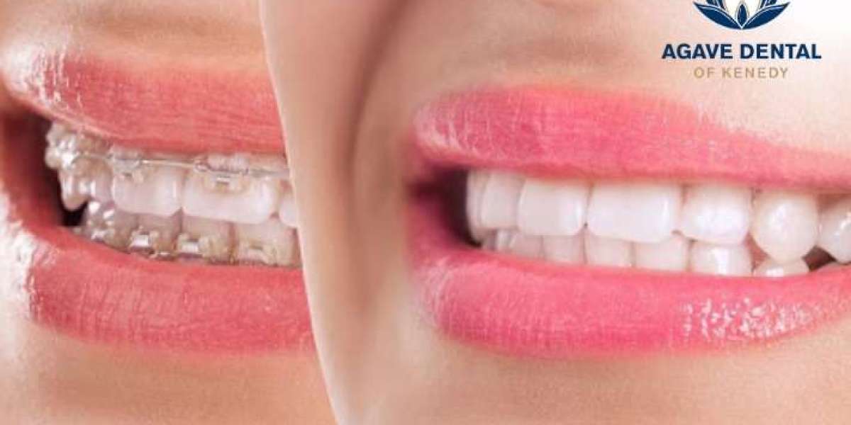 Dental Braces: A Comprehensive Guide to Achieving a Perfect Smile