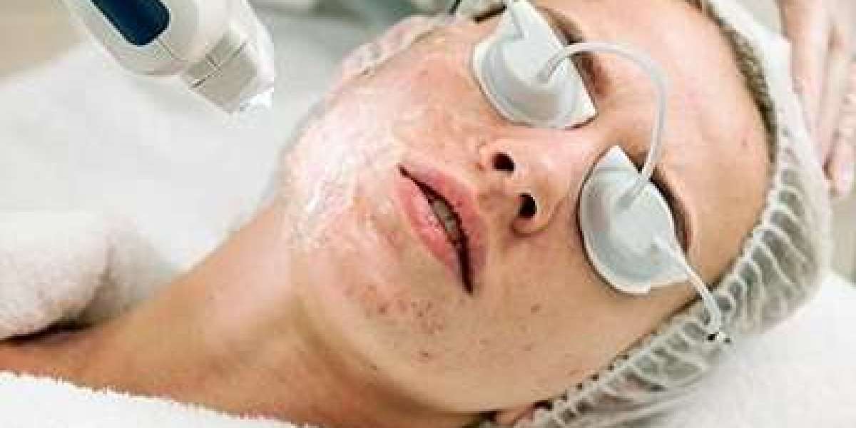 Microneedling Benefits for Acne Scar Treatment