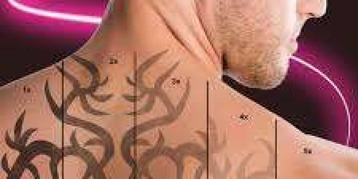 Laser Tattoo Removal in Fort Lauderdale: A Complete Guide