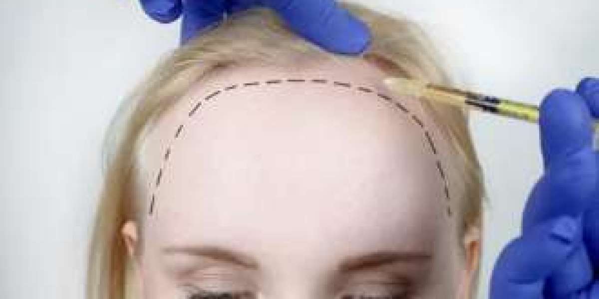 Understanding the Cost of Hair Transplantation in Abu Dhabi