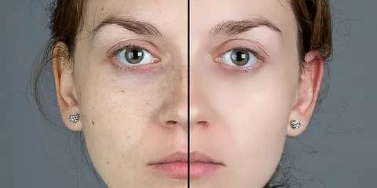 Effective Freckles and Blemishes Solutions in Dubai