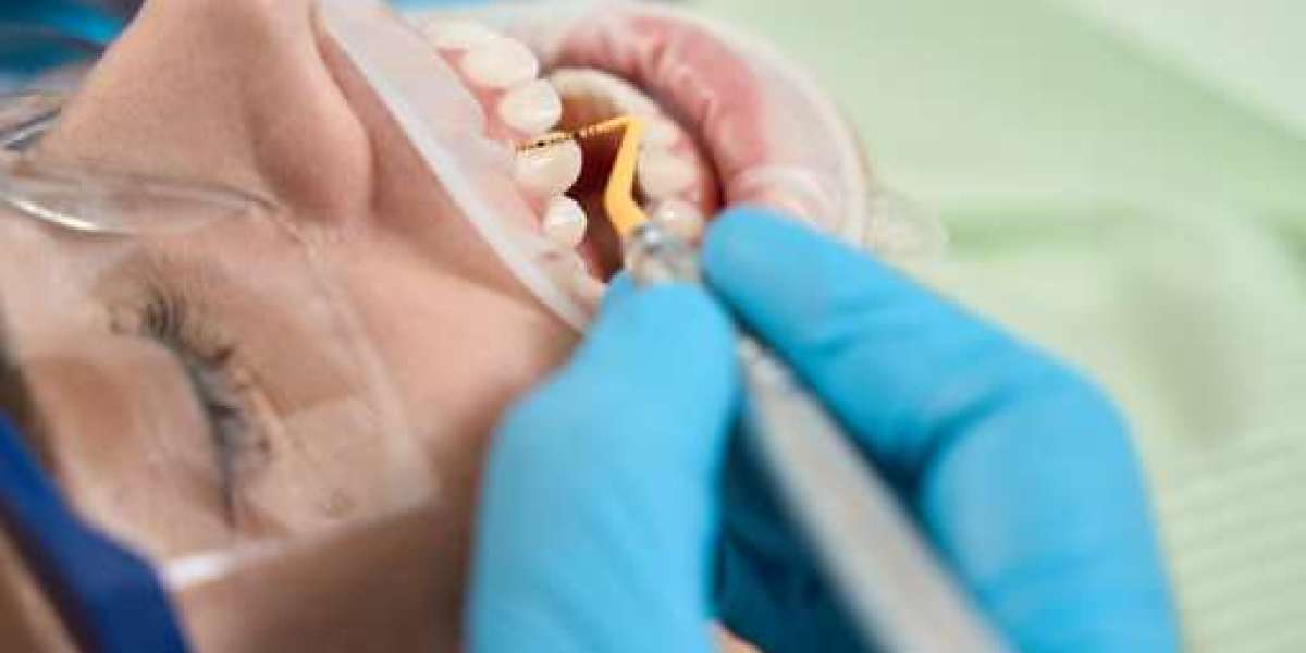 Removing Plaque and Tartar Through Scaling: A Key to Preventing Oral Diseases