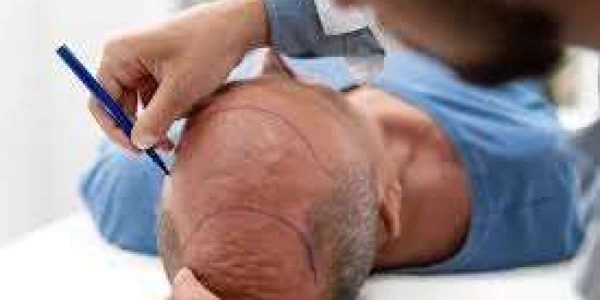 What’s the Price of a Hair Transplant in Riyadh?