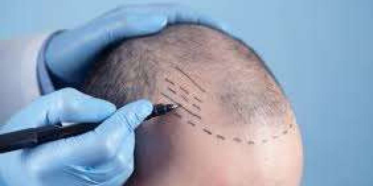 Hair Transplants for Every Budget in Riyadh