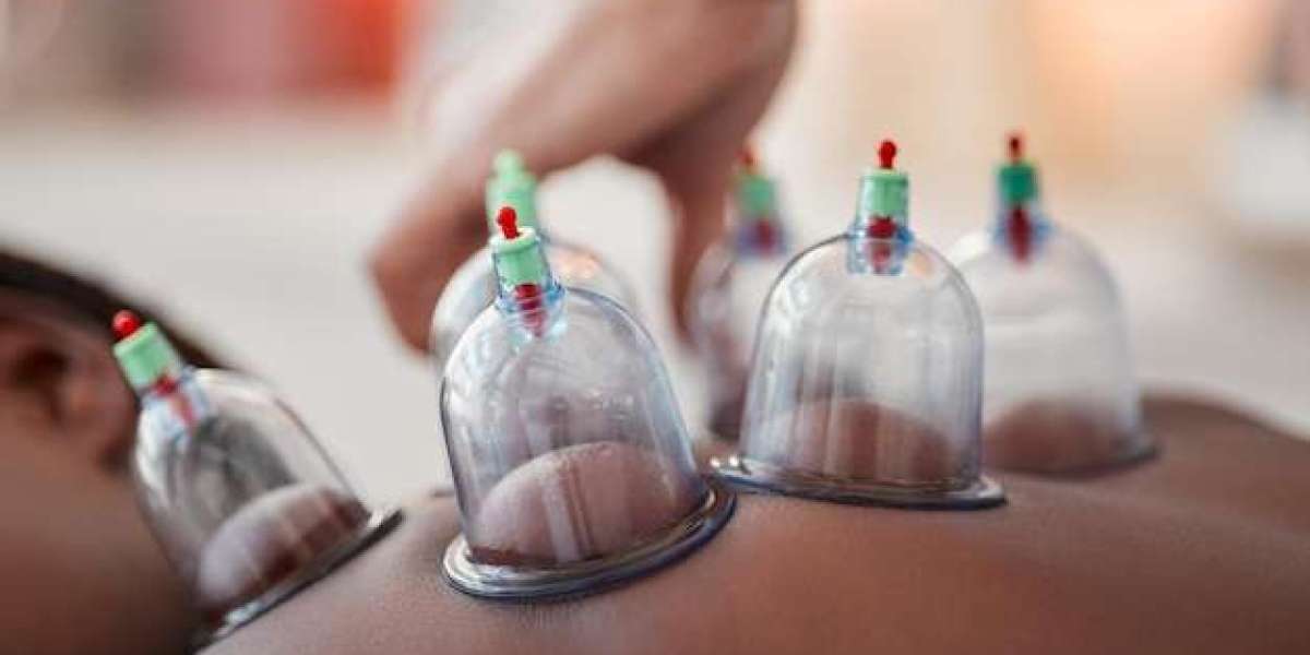 Hijama Cupping Therapy: The Key to Long-Lasting Health