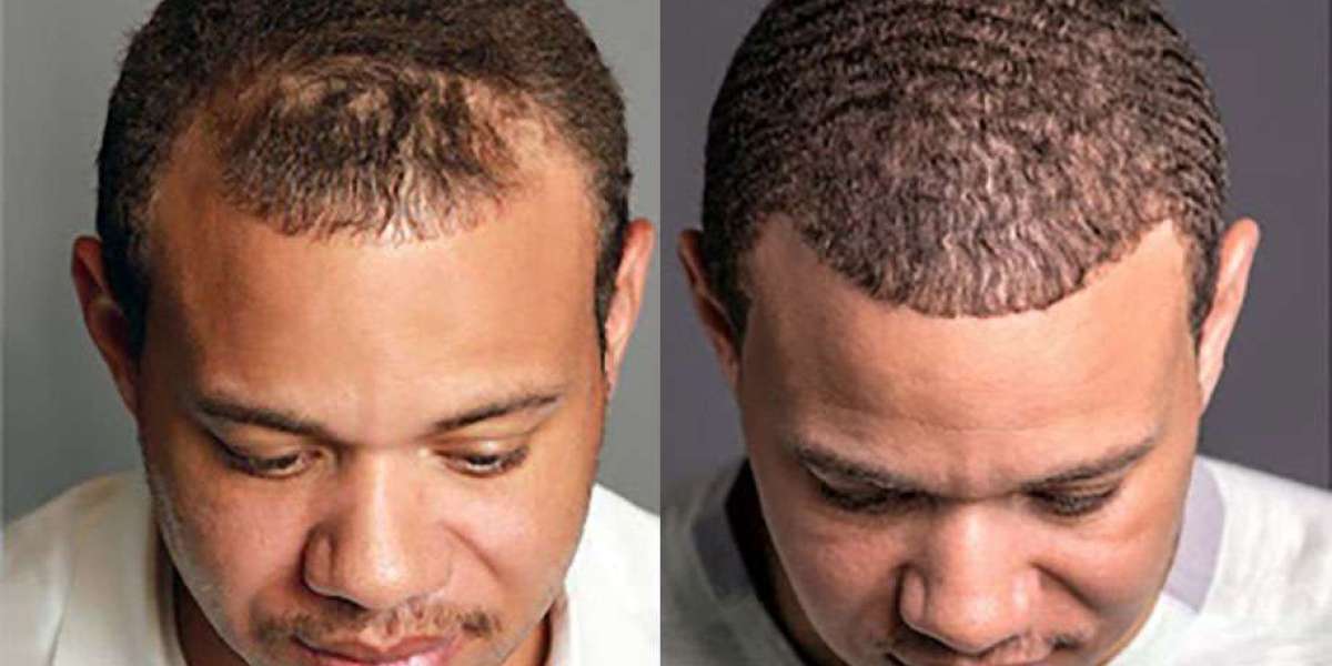 Is Hair Transplant Safe? What to Consider Before Getting One