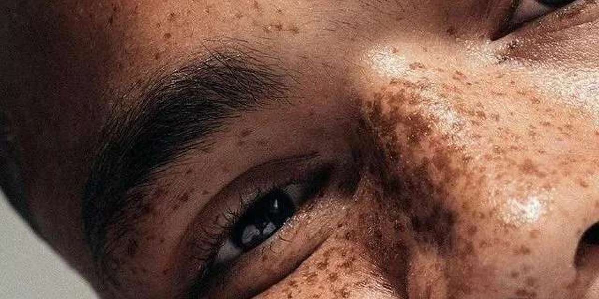 Top 10 Tips to Prevent Dermal Pigmentation from Returning in Islamabad