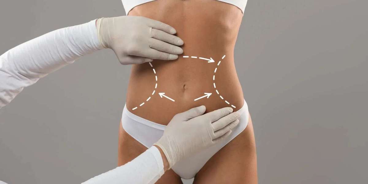 Understanding the Liposuction Procedure: A Comprehensive Guide to Liposuction in Islamabad