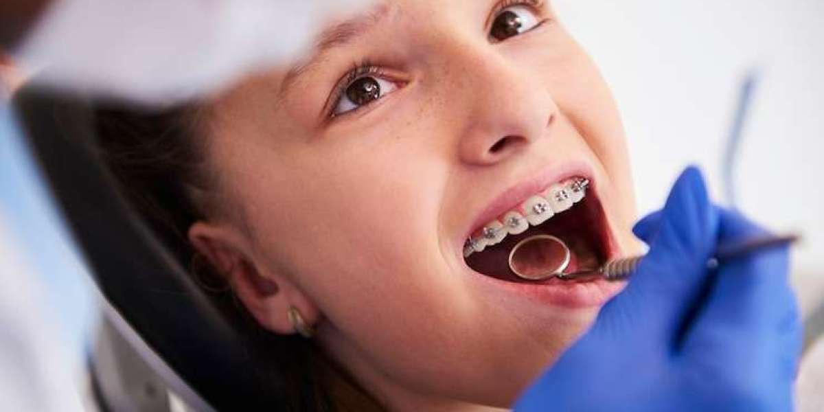 A Comprehensive Guide to Choosing the Right Teeth Braces