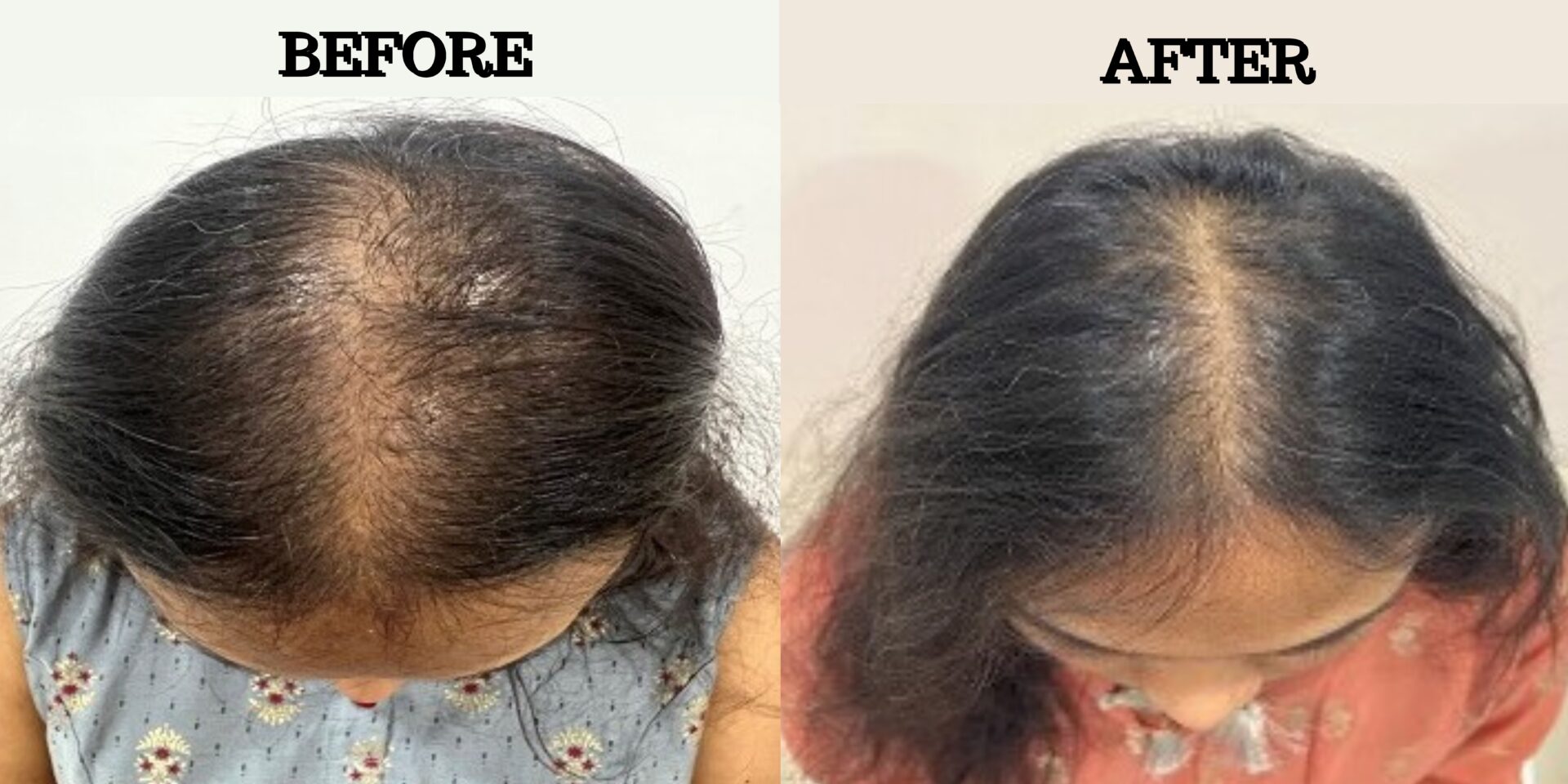 # 1 Clinic For GFC Hair Treatment in Hyderabad: Clinica Derm