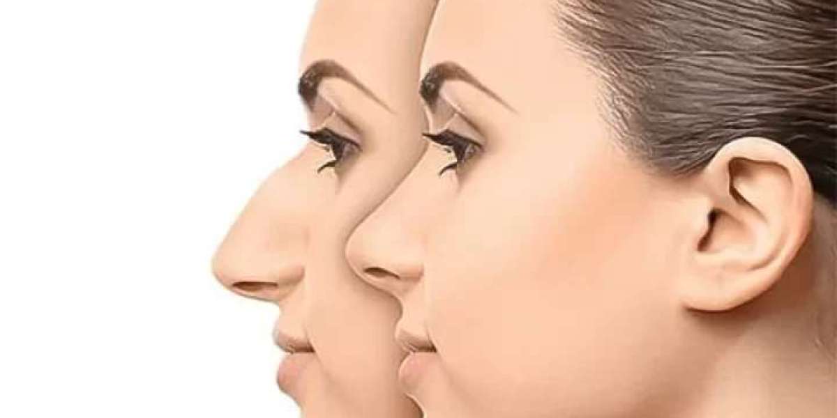 How Long Does Rhinoplasty Recovery Take?