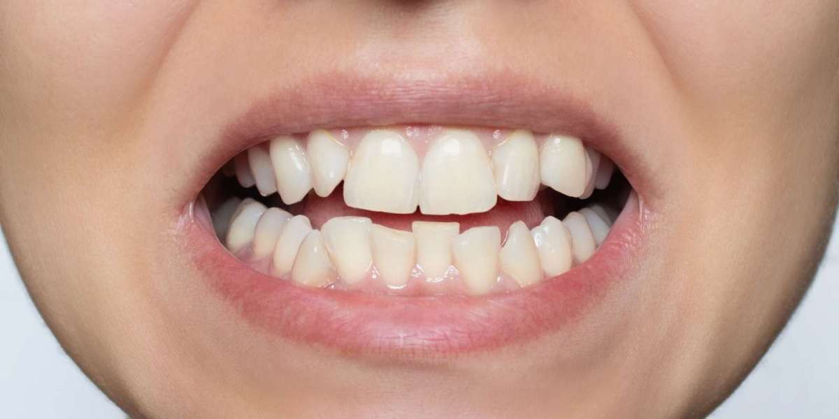 The Journey to a Brighter Smile: Teeth Whitening Explained